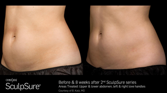 Sculpsure Laser Fat Reduction, Buy Two Treatments, Get a Third Treatment to the Same Area FREE!